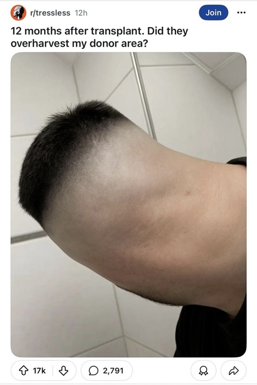 12개월차 모발 이식 후기